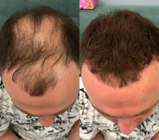 Hair Density Filler