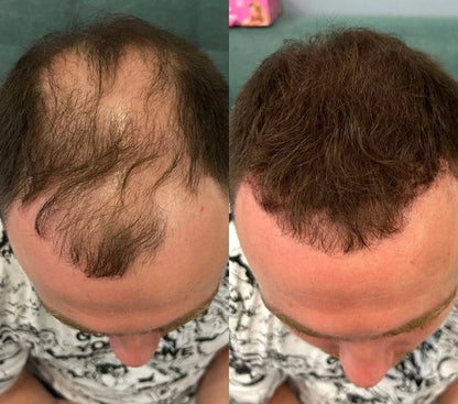 Hair Density Filler
